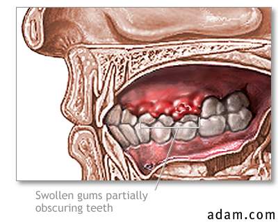 Swollen gums