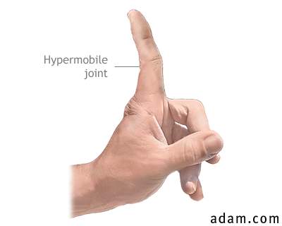 Hypermobile joints