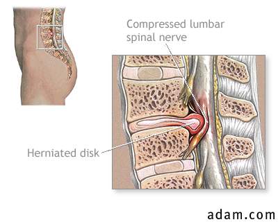 Herniated lumbar disk
