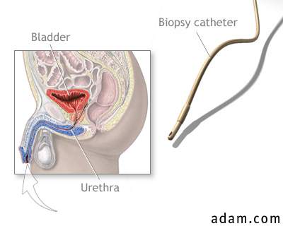 Bladder biopsy