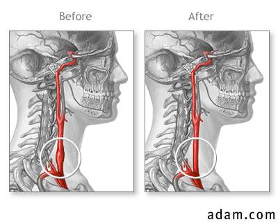 Before and after carotid surgery