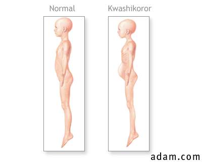 Kwashikoror symptoms