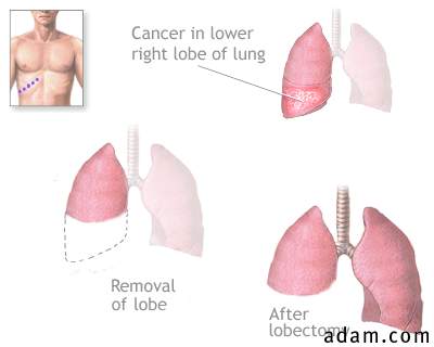 Lung lobectomy