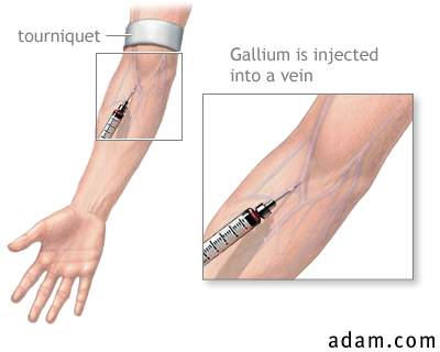 Gallium injection