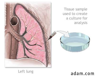 Lung tissue biopsy