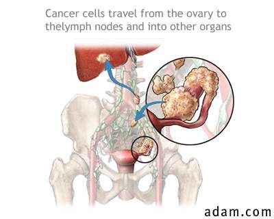 Ovarian cancer metastasis