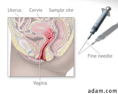 Cervix needle sample