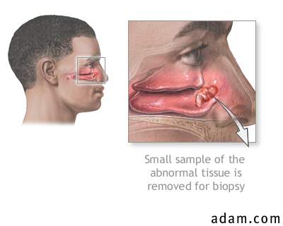 Nasal biopsy