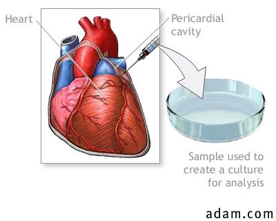 Pericardial fluid culture