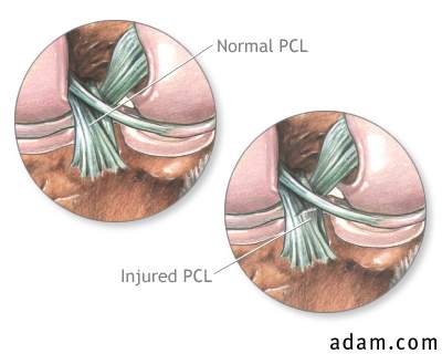 Posterior cruciate ligament injury
