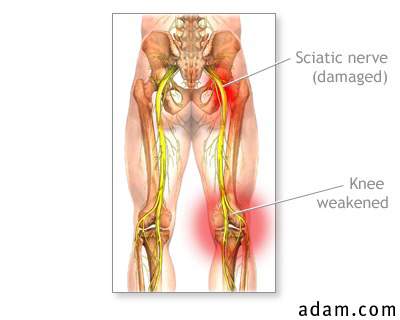 Sciatic nerve damage