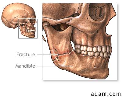 Mandibular fracture