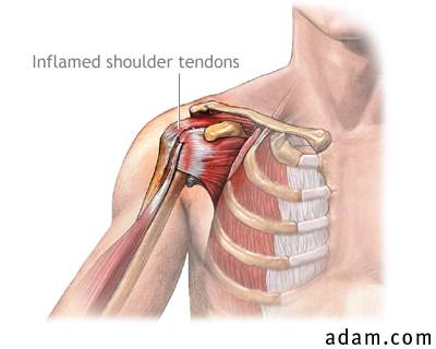 Inflammed shoulder tendons