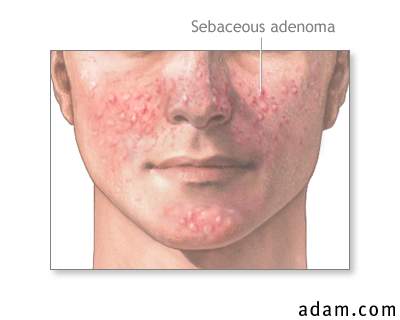 Sebaceous adenoma