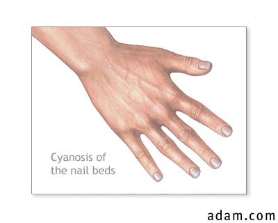 Cyanosis of the nail bed