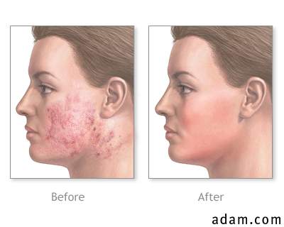 Before and after skin smoothing surgery