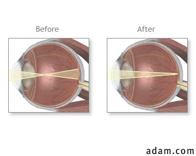 Before and after eye repair