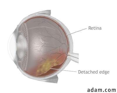 Detached retina