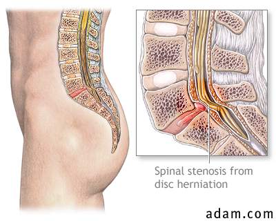Spinal stenosis