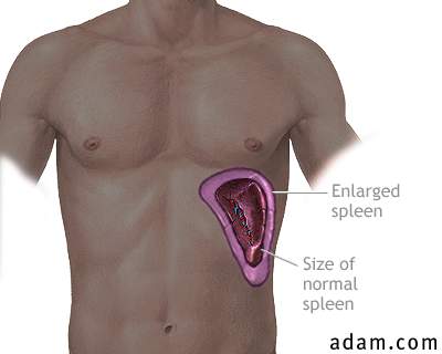 Enlarged spleen