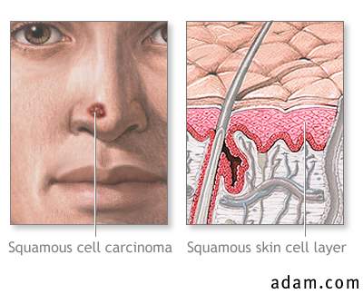 Squamous cell cancer