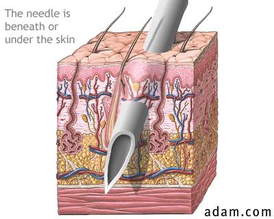 Skin layers and needles