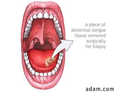Tongue biopsy