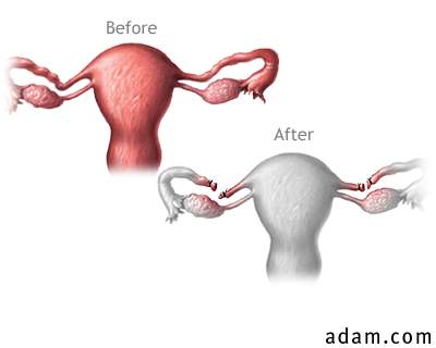 Before and after tubal ligation