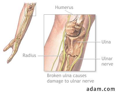 Ulnar nerve damage