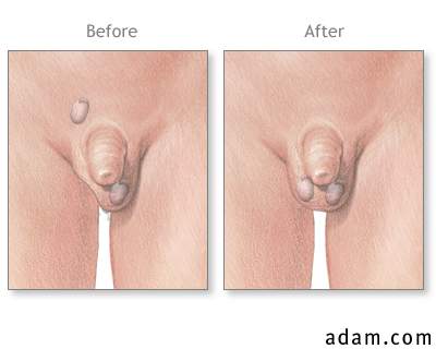 Before and after testicular repair